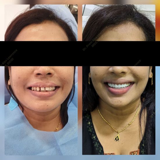 All-On-4-Treatment-patient-chennai